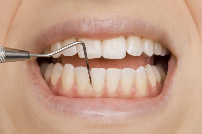123RF.com nuotr./Dantų ir burnos higiena ypač svarbi parodontozės prevencijai