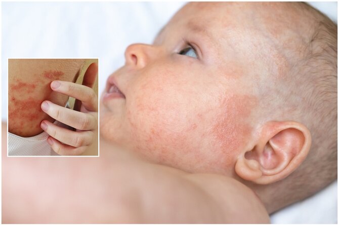Shutterstock nuotr./Atopinis dermatitas / Egzema