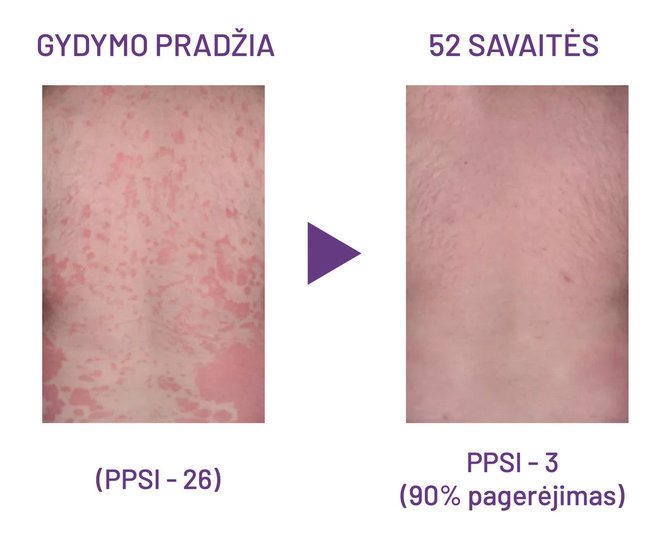 KUL nuotr./Sisteminio gydymo biologine terapija rezultatai: pradžia ir pabaiga