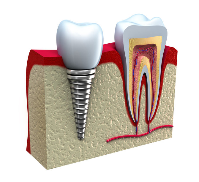„Shutterstock“ nuotr./Danties implantas – tai danties šaknies pakaitalas, ant kurio tvirtinamas protezas (dar vadinamas vainikėliu).