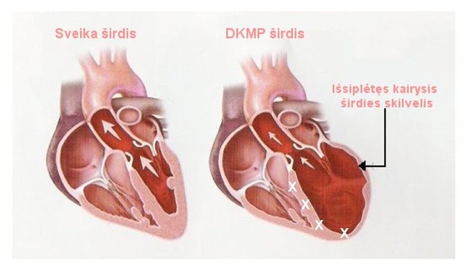 sveikas.lt/Sveiko (kairėje) ir sergančio dilatacine kardiomiopatija žmogaus širdis