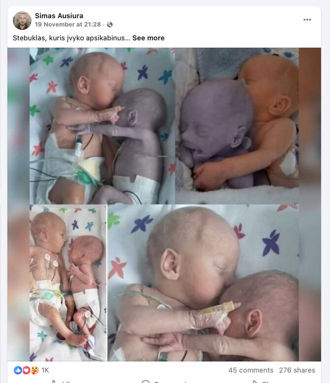Ekrano nuotr. iš „Facebook“/Istorija apie naujagimę, kuri savo apkabinimu padėjo stabilizuoti dvynės sesers būklę, yra tikra, tačiau jų nuotraukos buvo pakeistos - mažylės kūnas nebuvo tokios pilkai mėlynos spalvos