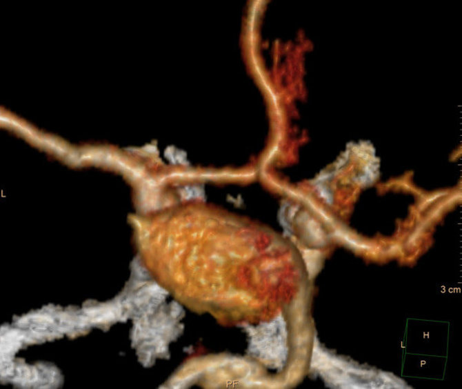 Kauno klinikų nuotr./Keliasdešimt kartų išdidintas galvos smegenų kraujagyslių vaizdas, matomas erdvinis kraujagyslių medis ir centre – pailgo maišo formos didelė arterinė aneurizma (siekia apie 3 cm x 1,7 cm dydžio).