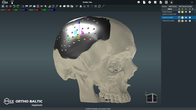 Ortho Baltics archyvo nuotr./Kranialinis implantas