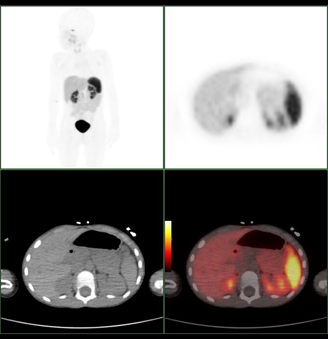 Kauno klinikų nuotr./PET/KT diagnostiniai vaizdai