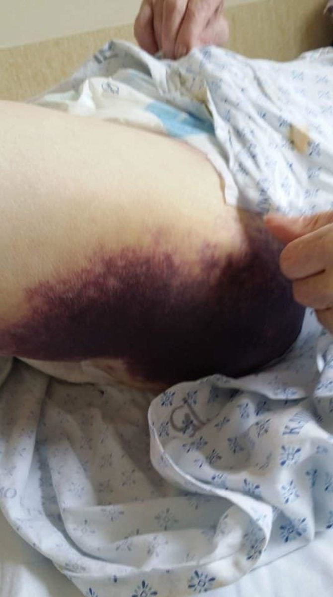 Skaitytojos nuotr./Ant pacientės Stasės kojos atsiradusi hematoma