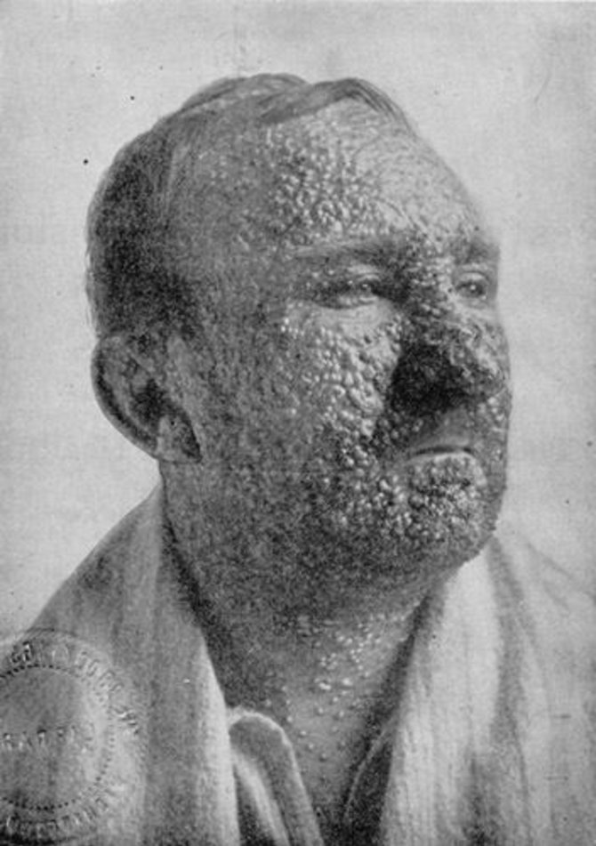 Wikimedia Commons nuotr./Raupais sergantis žmogus, 1912 m.