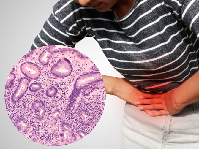 Shutterstock nuotr./H. pylori
