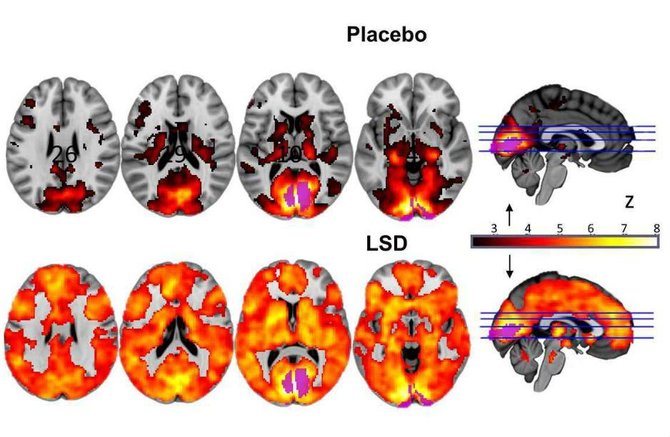 Imperatoriškojo Londono koledžo nuotr./Smegenų palyginimas – viršuje – įprastai veikiančios žmogaus smegenys, apačioje – paveiktos LSD