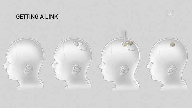 AFP/„Scanpix“ nuotr./„Neuralink“ implantas pakeistų dalį kaukolės