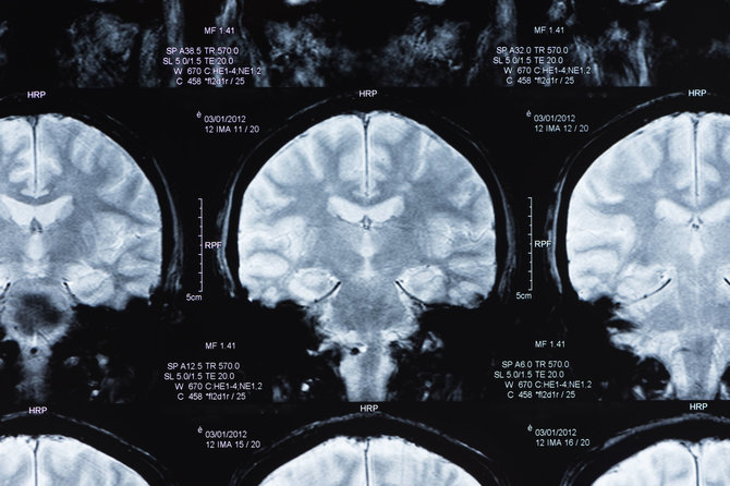 123RF.com nuotr./Smegenų tyrimas magnetiniu rezonansu 