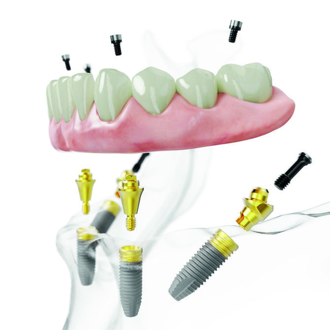 „Nobel Biocare“ nuotr./Naudojant All-on-4® gydymo metodiką visi vieno žandikaulio dantys atkuriami ant 4 implantų