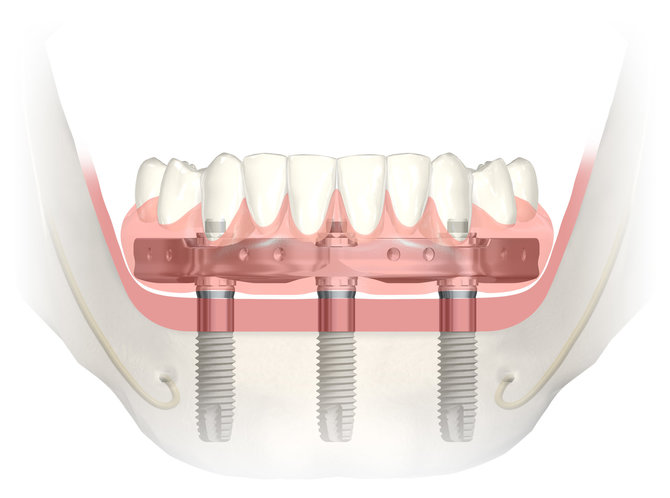 „Nobel Biocare“ nuotr./Su Trefoil ™ gydymo metodika visi apatinio žandikaulio dantys atkuriami ant trijų implantų, ant kurių iškart tvirtinami nuolatiniai dantys