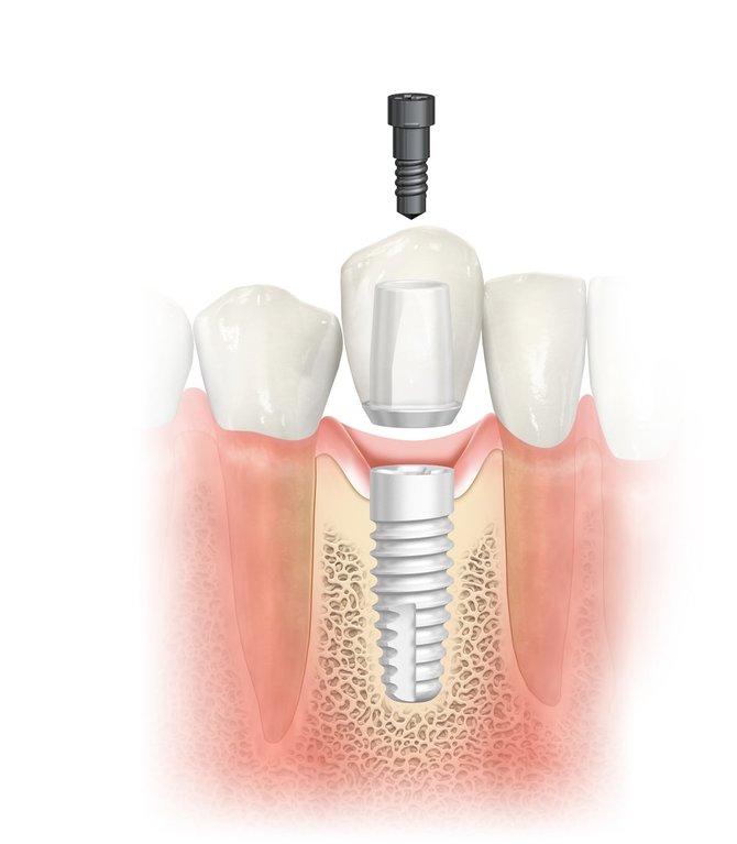  „Nobel Biocare“ nuotr./„NobelPearl“ 100 proc. bemetalis implantas su prisukama atrama.