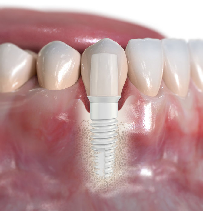 „Nobel Biocare“ nuotr./„NobelPearl“ keraminis dantų implantas.
