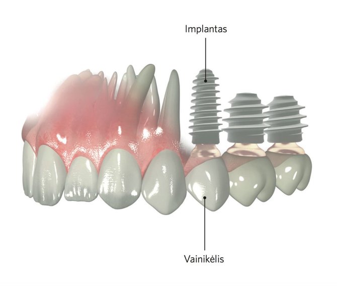 Projekto partnerio nuotr./Dantų implantas
