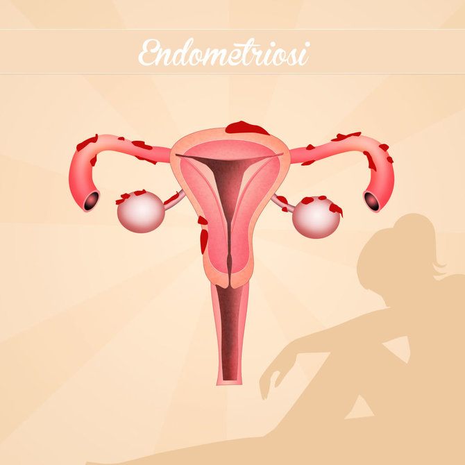 123RF.com nuotr./Endometriozės paveikta gimda