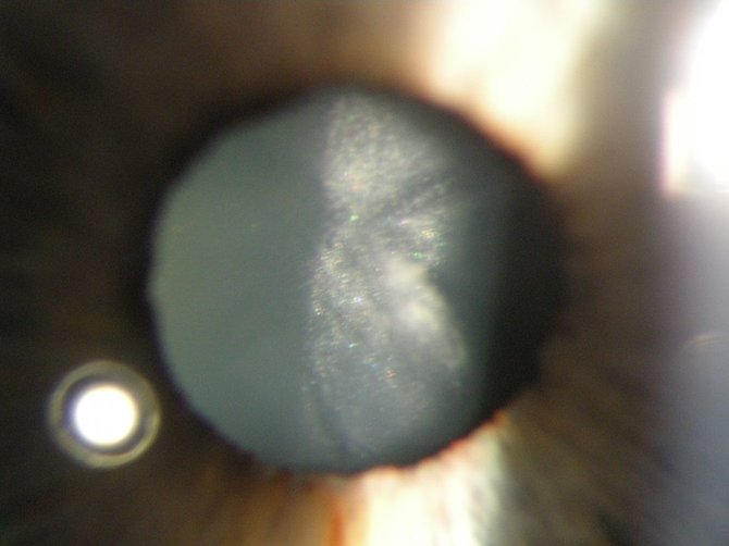 gyd. A. Makselio nuotr. /Akies vyzdys esant kataraktai 