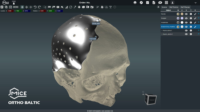 „Ortho Baltic“ archyvo nuotr./Su 3D priešoperacinio planavimo programa MICE stebimos kaulo su implantu kontaktinės zonos 