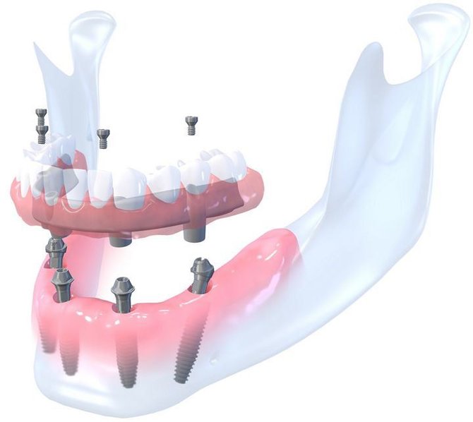 Dantų atkūrimas su 4 implantais