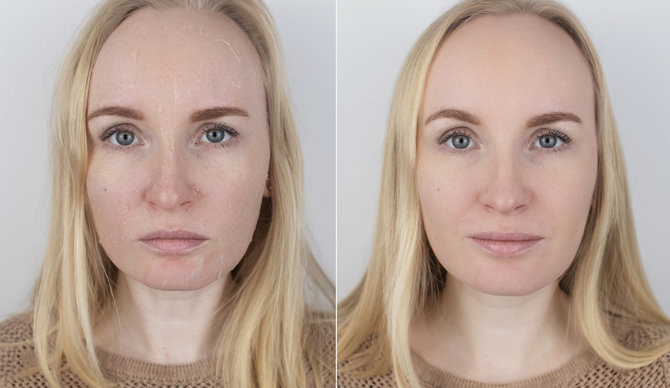 123RF.com nuotr./Šaltuoju metų laiku veido odos būklė gali stipriai pablogėti
