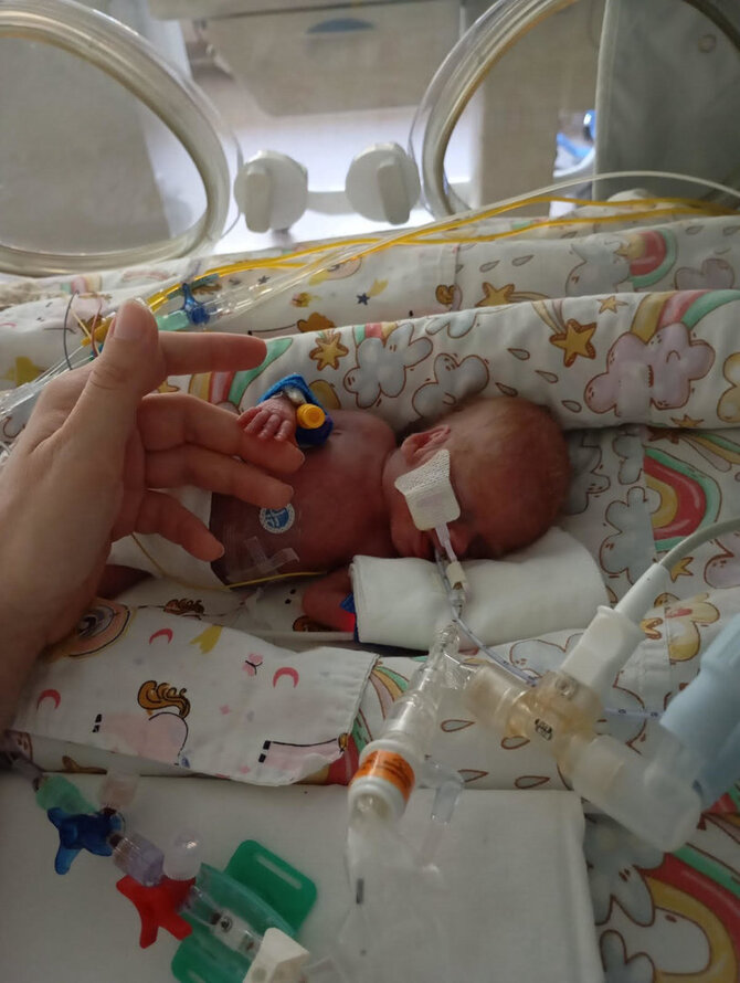 Kauno klinikų nuotr. /Klaudija gimė 22 savaičių ir 390 gramų svorio 