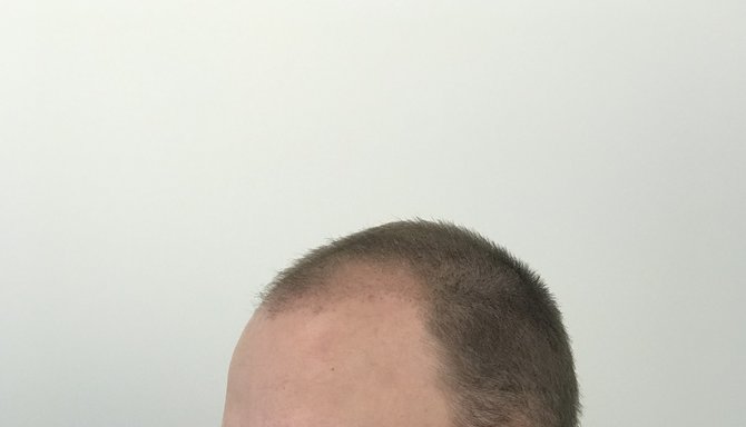 „Hair Clinic” nuotr./1 mėnuo po plaukų transplantacijos
