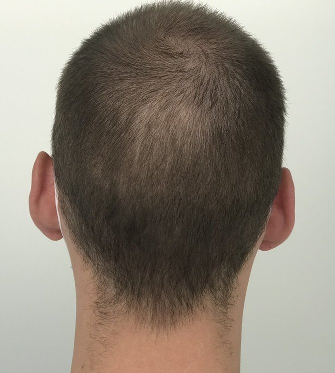 „Hair Clinic” nuotr./Mėnuo po plaukų transplantacijos