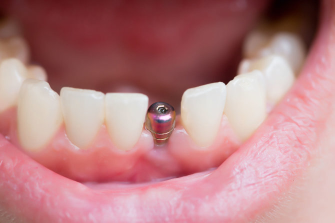 123RF.com nuotr./Dantų implantas