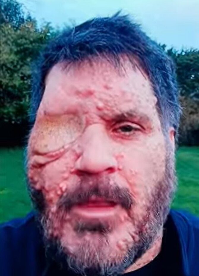 Youtube stop. kadras/44 metų Oliveris Bromley gimė su neurofibromatoze – reta, visą gyvenimą trunkanti genetinė liga, pasireiškiančia gerybinių navikų augimu. 