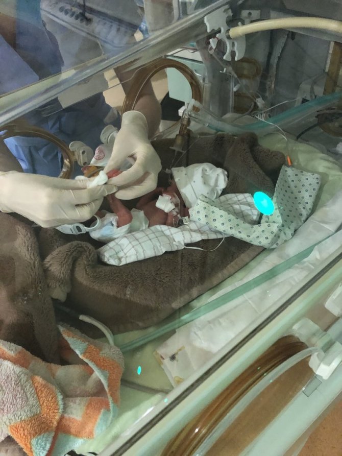 Asmeninė nuotr./Godos dukrytė Austėja gimė 23 savaičių ir svėrė kiek daugiau nei 500 gramų