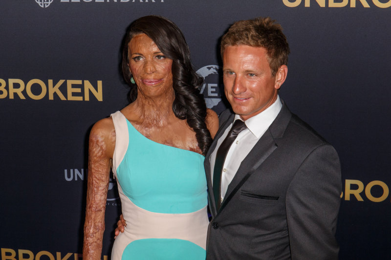 Turia Pitt ir Michaelas Hoskinas