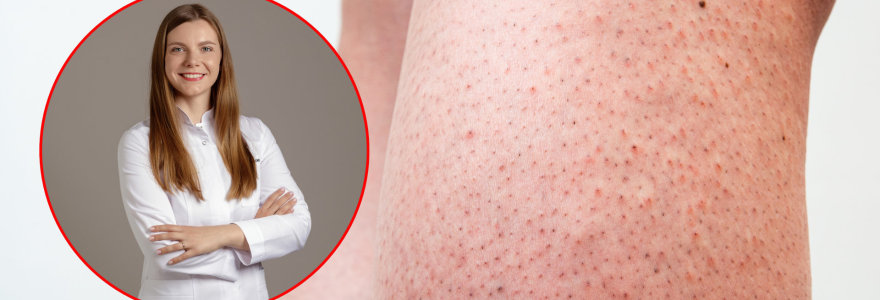 Gydytoja dermatologė Aurėja Kontrimienė pataria, kaip išvengti braškinės odos