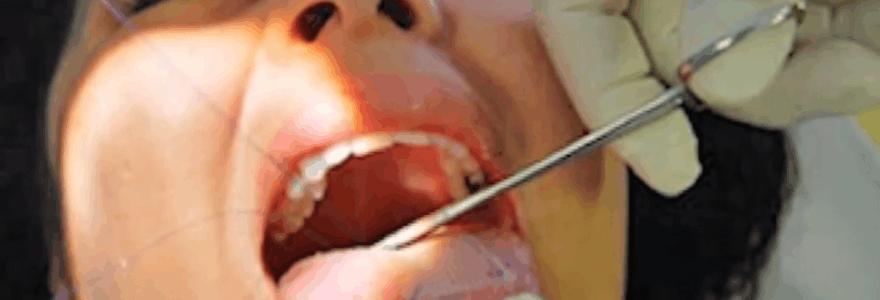 Pacientei ant liežuvio siuvamas normalią mitybą trikdantis plastikinis tinklelis