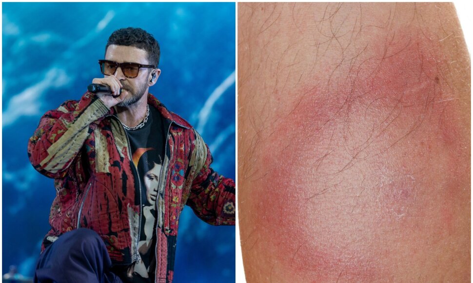 Justinui Timberlake'ui diagnozuota Laimo liga