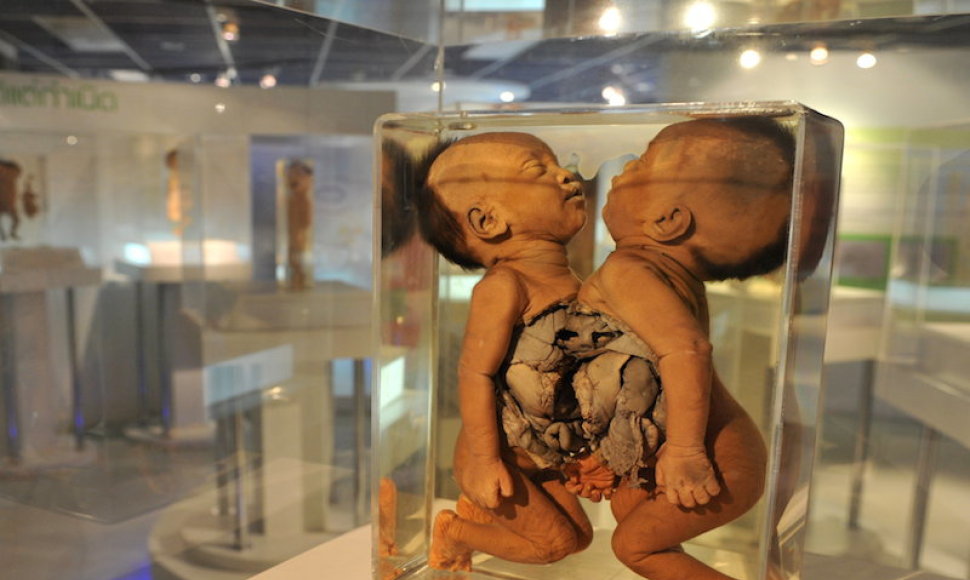 Siriraj medicinos muziejuje kai kurie eksponatai priverčia krūptelėti