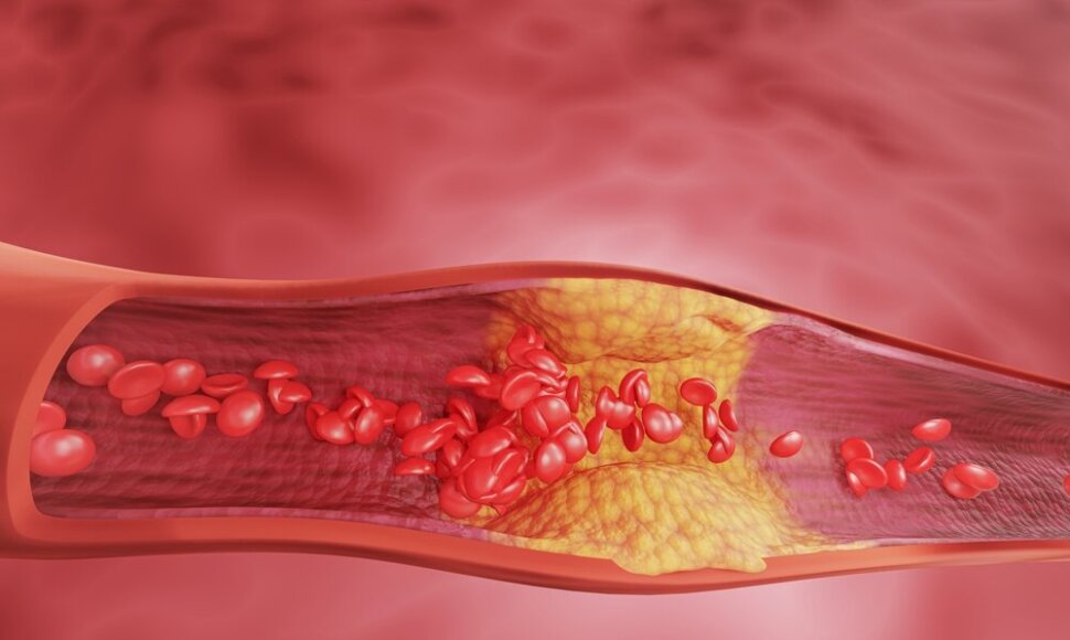 Cholesterolis