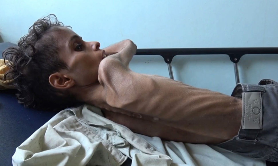 Jemene badauja daugybė vaikų