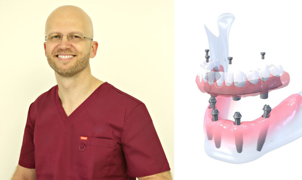 Vakarietiška implantacija Lietuvoje. Kokias metodikas atvežė gydytojas?