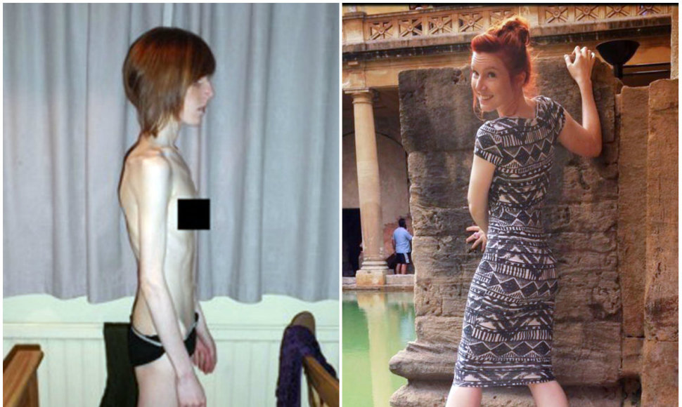Kairėje: Beth Hall serganti anoreksija, dešinėje: Beth Hall šiuo metu