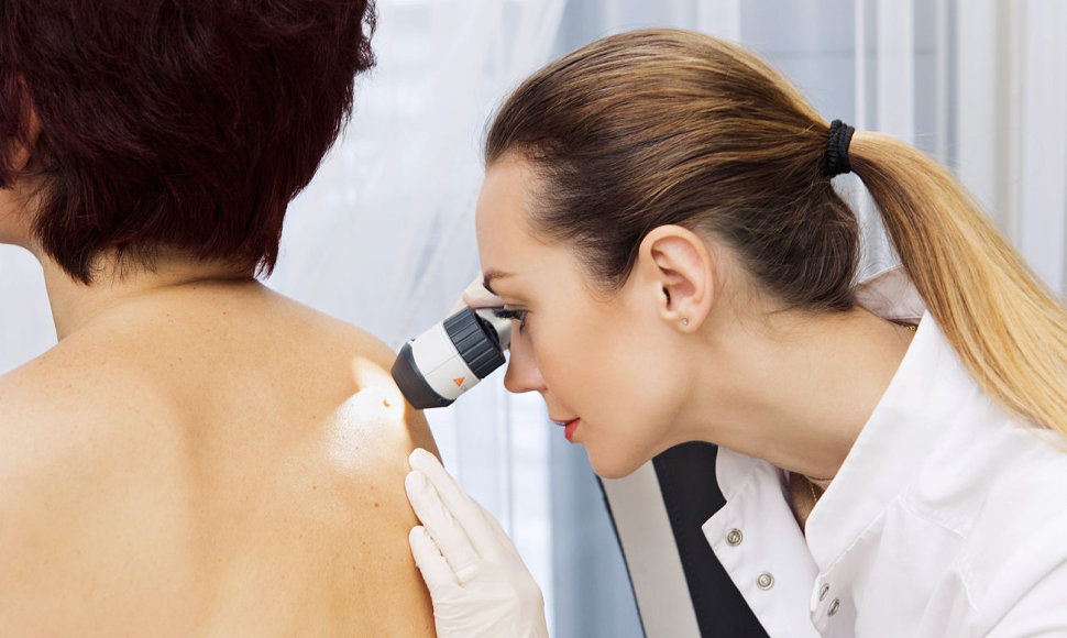 Dermatologė apžiūri apgamą 