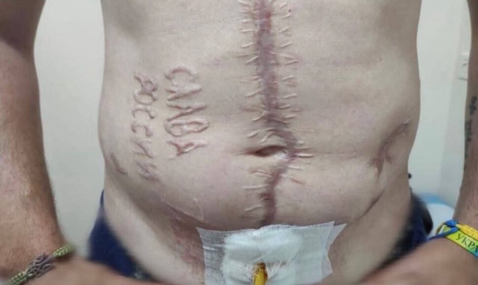 Nuotrauka, kurioje matyti i&scaron; Rusijos nelaisvės grįžęs Ukrainos kari&scaron;kis su ant pilvo i&scaron;raižytu užra&scaron;u &bdquo;&Scaron;lovė Rusijai&ldquo;