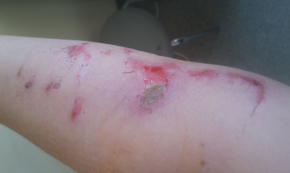 Po operacijos Kauno klinikose pacientė atsibudo sužalota ranka