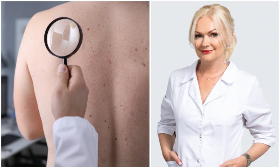 Dermatovenerologė Inga Valavičienė – apie įvairiaspalvę dedervinę