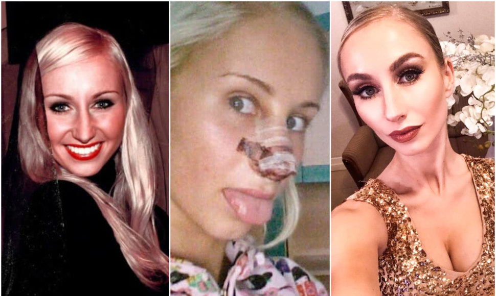 Kristina Tarasevičiūtė pripažino pasidariusi nosies rekonstrukciją. Kairėje - nuotrauka prieš operaciją, dešinėje - po jos. 
