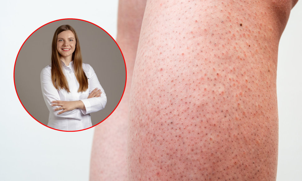 Gydytoja dermatologė Aurėja Kontrimienė pataria, kaip išvengti braškinės odos