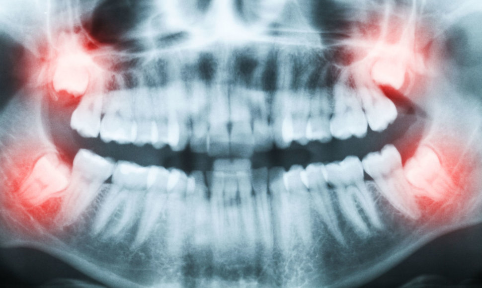 Dantų rentgenas