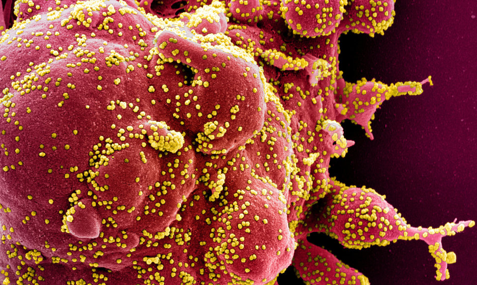 Mirštanti žmogaus ląstelė, kurioje prisigamino daugybė koronaviruso kūnelių (virusas – geltoni taškeliai)
