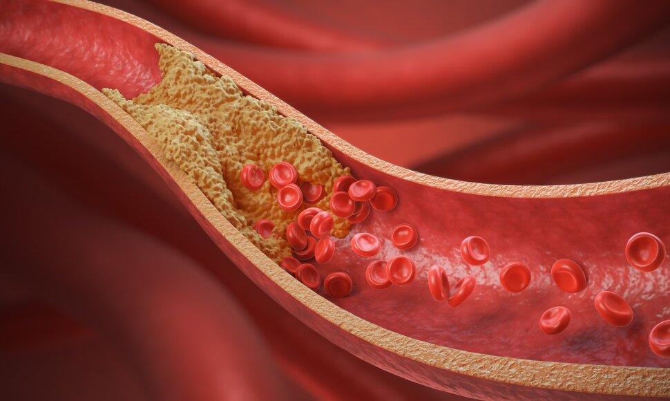 Cholesterolis