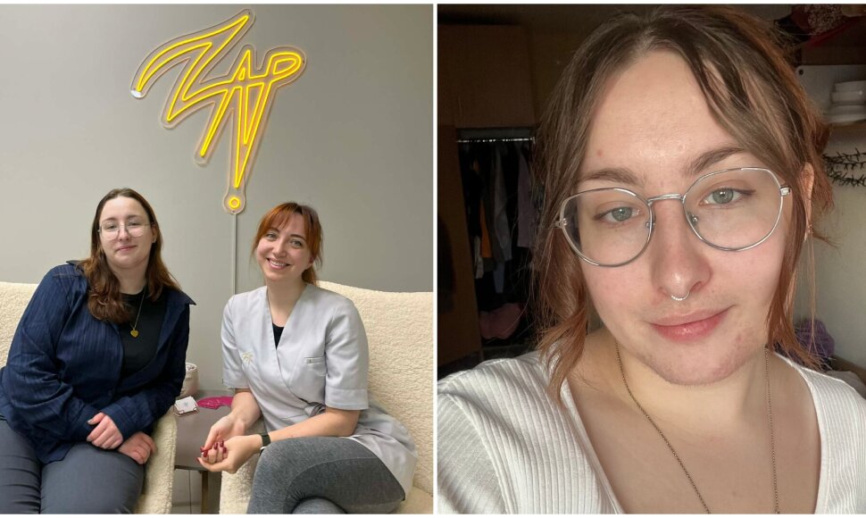 Amanda pasidalino savo kova su veido plaukuotumu
